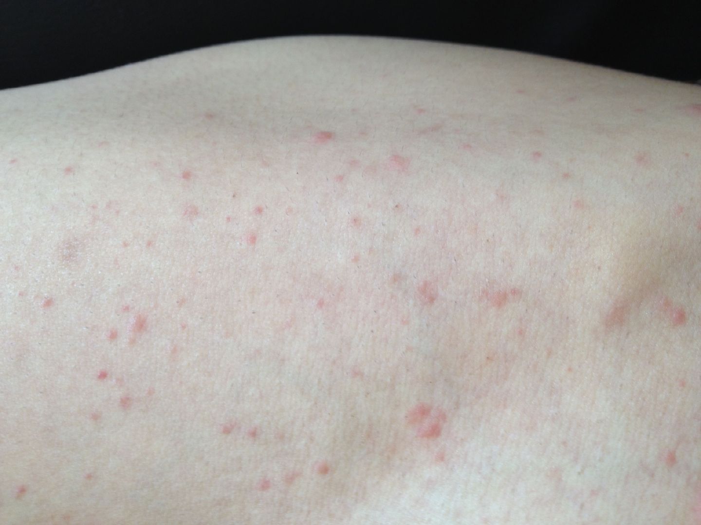 不慎接触艾滋病毒有72小时自救， 艾滋病初期症状