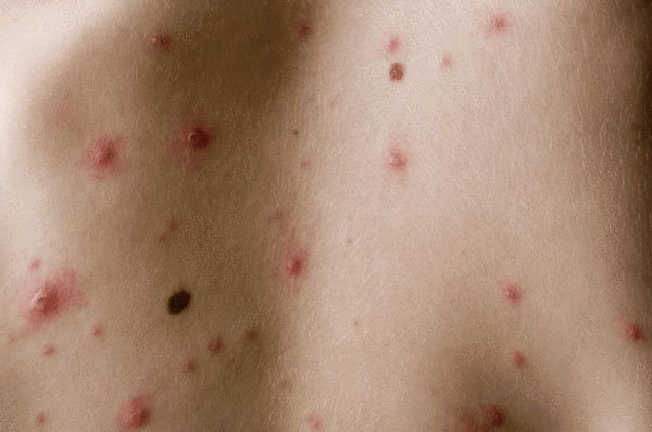 不慎接触艾滋病毒有72小时自救， 艾滋病初期症状