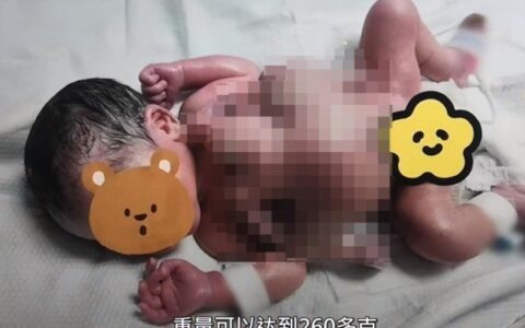 深圳一男婴出生时4手4脚，发生概率50万分之一