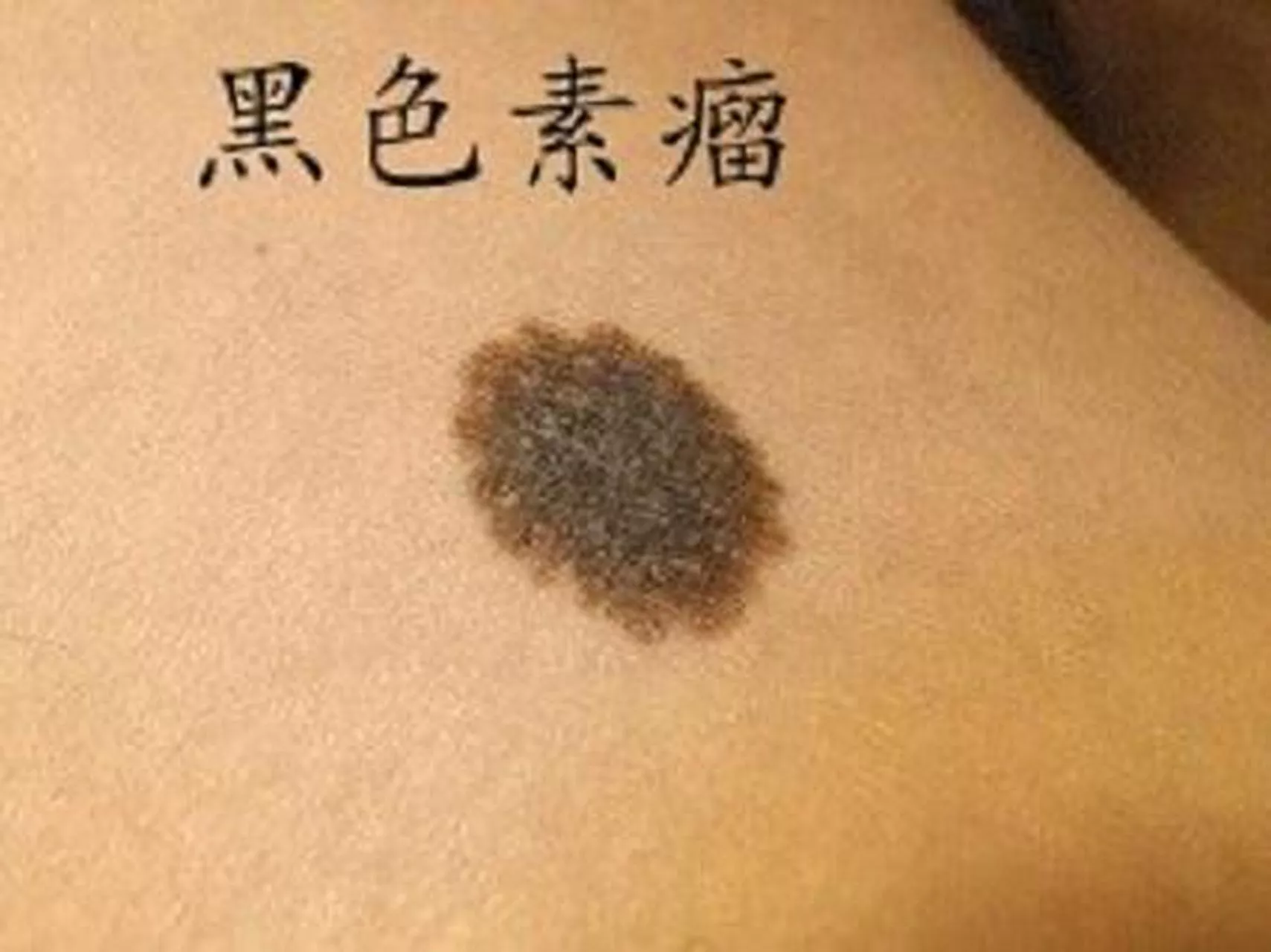 如何分辨黑色素瘤和普通痣？